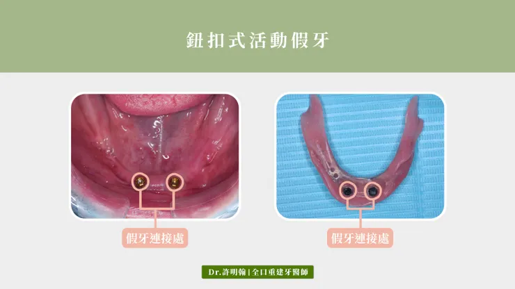 鈕扣式活動假牙、覆蓋式活動假牙、植體覆蓋式活動義齒