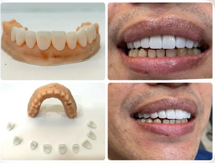 渥爾牙醫:自建數位牙技中心,讓美白貼片(鋯白貼片)成為最具性價比的牙齒美白選擇!