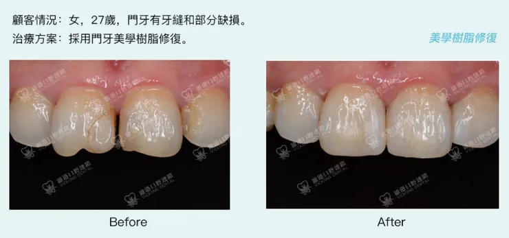 深圳門牙牙罅補牙案例