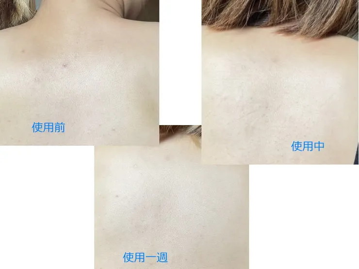 Laglow淨痘美體噴霧背痘噴霧使用前後比較圖