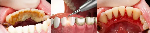 深圳洗牙費用多少