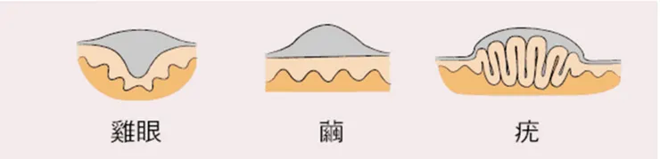 病灶在皮膚下的剖面圖(資料來源：網路)