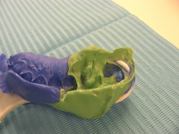 拔牙前的最後希望！牙齒的最後防線！渥爾牙醫用Cap-Lock技術守住天然牙！