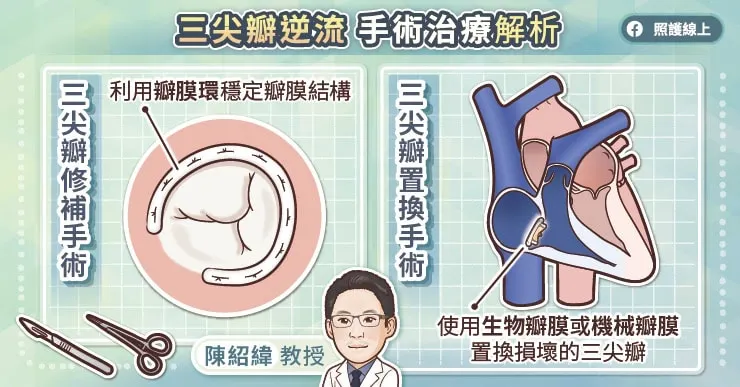 三尖瓣逆流手術治療