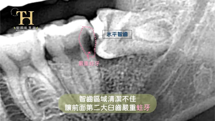 智齒，臉腫，蜂窩性組織炎