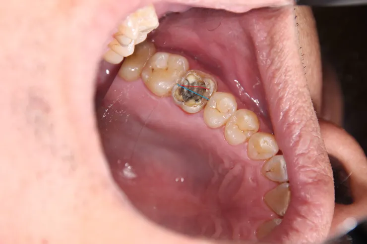 我後製畫圖，這樣就比較看得出裂痕，請與原圖比較