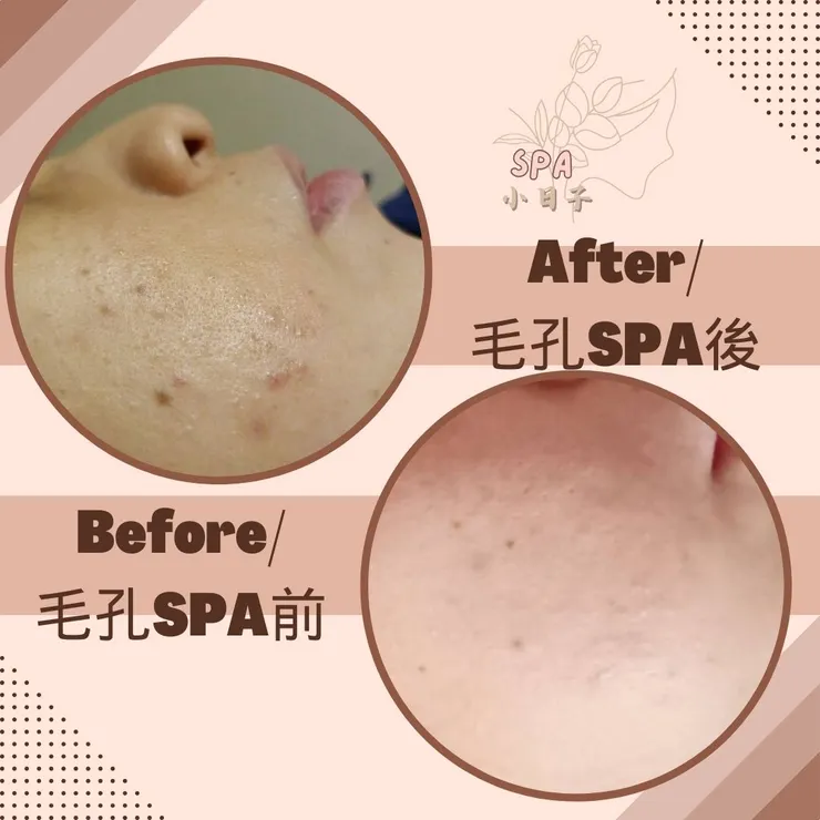 毛孔SPA前後對照圖/完全無修圖/無上妝 7天前後對照版