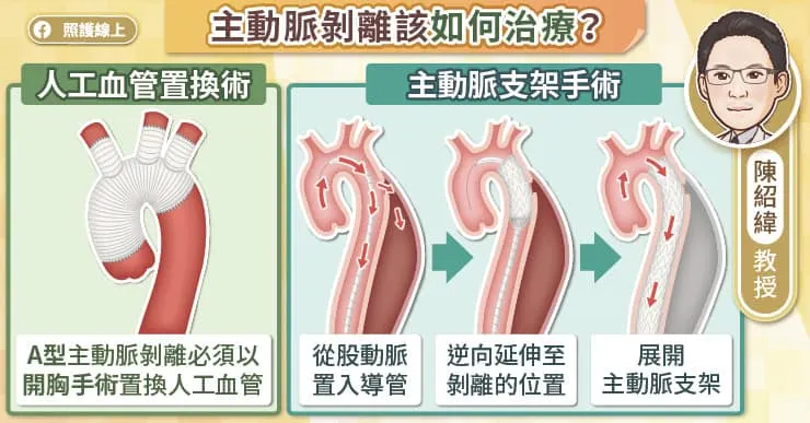 主動脈剝離該如何治療