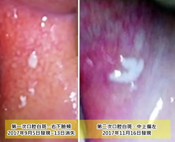 2017年9月~11月 第一.二次口腔白斑