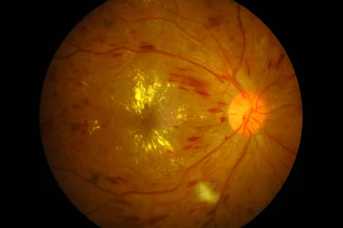 RETINA MACULA — RETINA MACULA SPECIALISTS OF MIAMI
