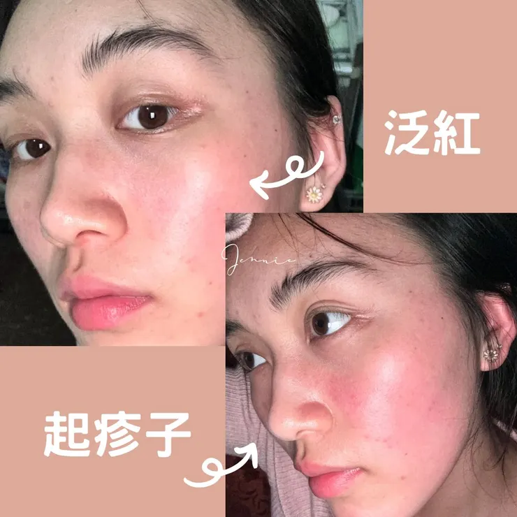 泛紅起疹子擦什麼