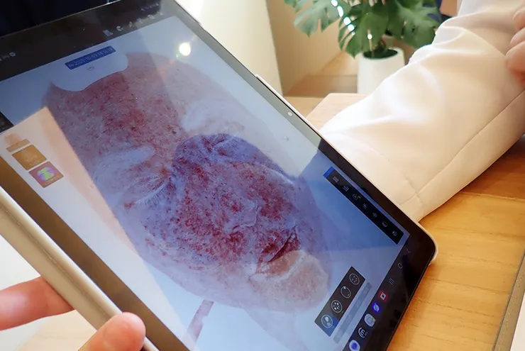 台北東區打雷射｜RedTouch PRO凍態雷射(果凍光)│台北打雷射推薦綻妍醫美診所