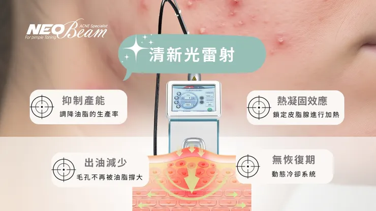 【控油新境界】油光滿面怎麼辦？Neobeam 清新光：從根源縮小皮脂腺的黑科技