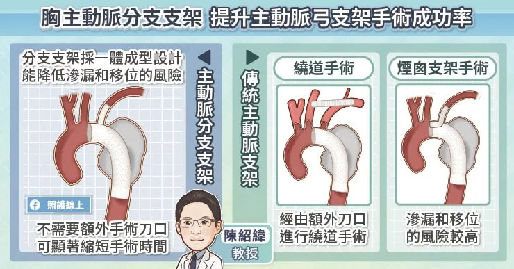 胸主動脈分支支架 提升主動脈弓手術成功率