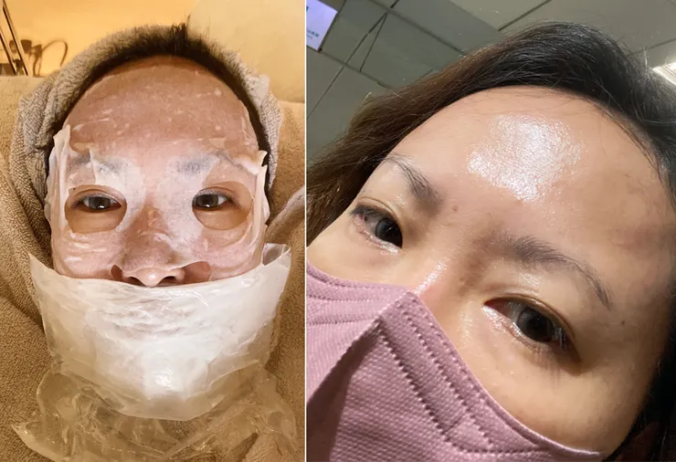 台北東區打雷射｜RedTouch PRO凍態雷射(果凍光)│台北打雷射推薦綻妍醫美診所