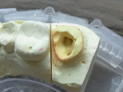 渥爾牙醫診所:蛀蝕深入牙肉下的修復挑戰!Cap-Lock全瓷系列拯救上顎第二大臼齒!