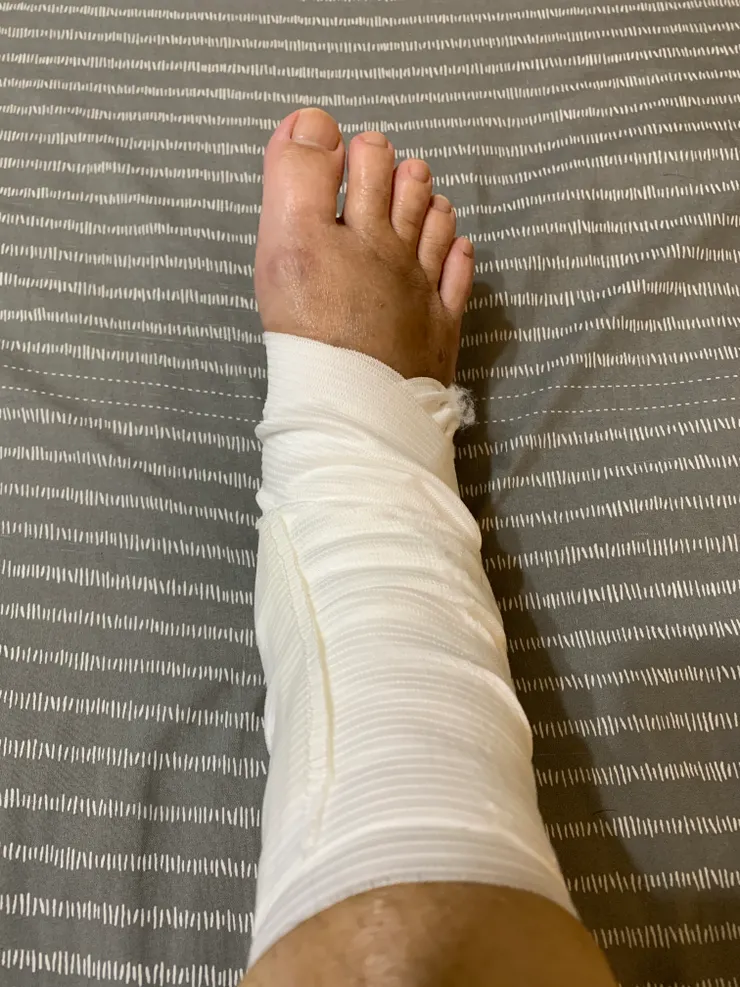 其實傷口小小的，包成這樣有點駭人