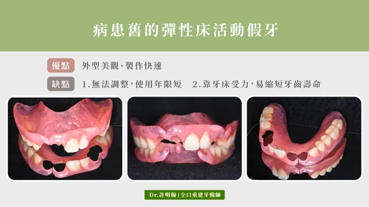 彈性床活動假牙的缺點