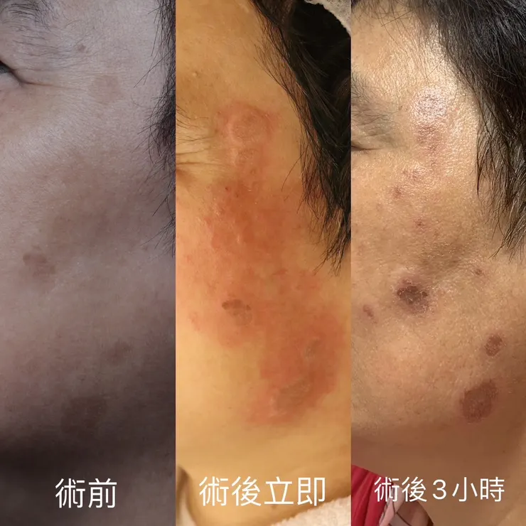 治療術後3小時