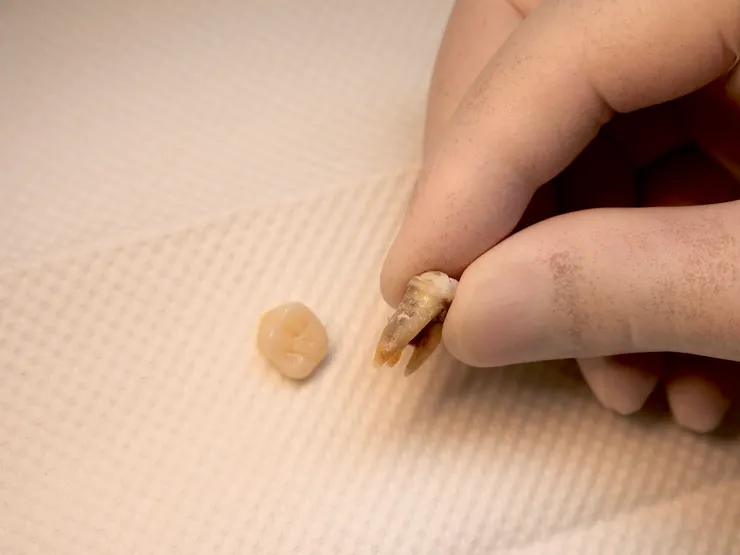 渥爾牙醫提醒！氧化鋯牙冠雖然很硬，但你還是不能亂咬！