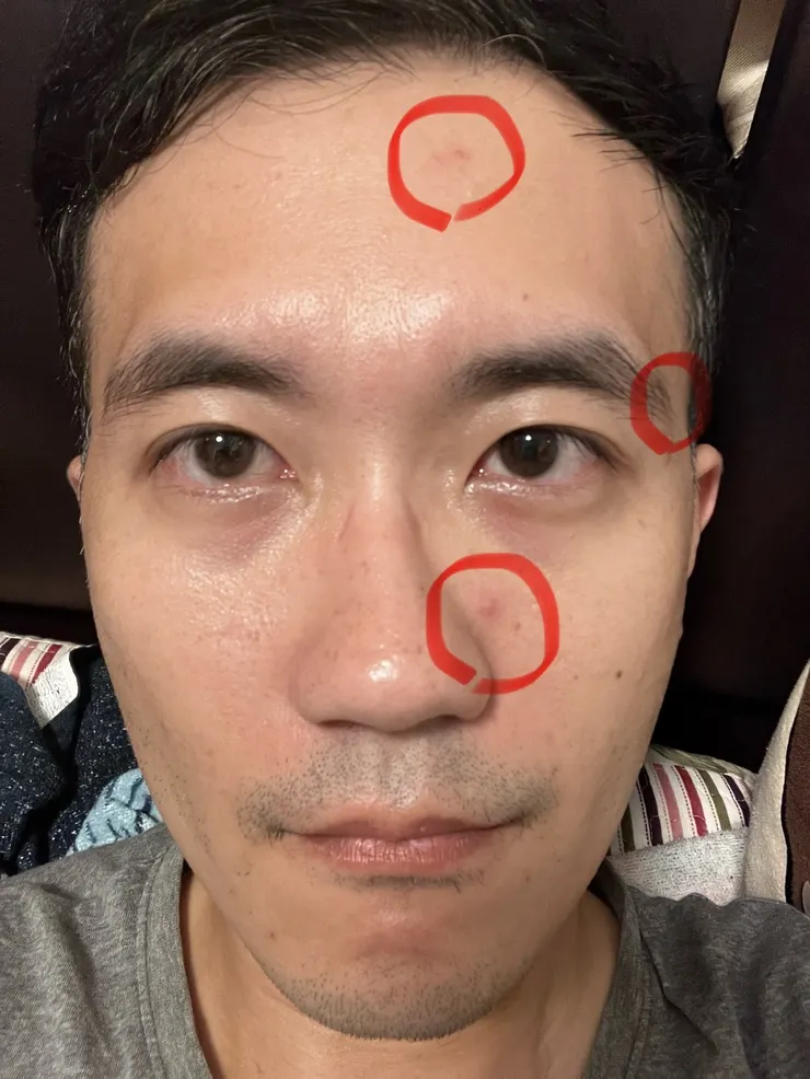 各個地方開始長痘痘