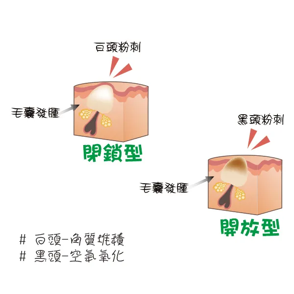 粉刺調理/除粉刺