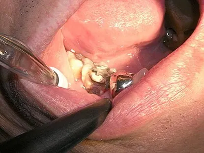 渥爾牙醫診所: Cap-Lock全瓷系列修復案例!斜裂下大臼齒的成功修復!