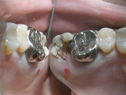 渥爾牙醫診所:蛀蝕深入牙肉下的修復挑戰!Cap-Lock全瓷系列拯救上顎第二大臼齒!