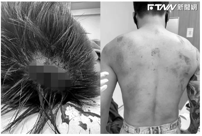 TOYZ頭破出一個深坑：到醫院縫十幾針