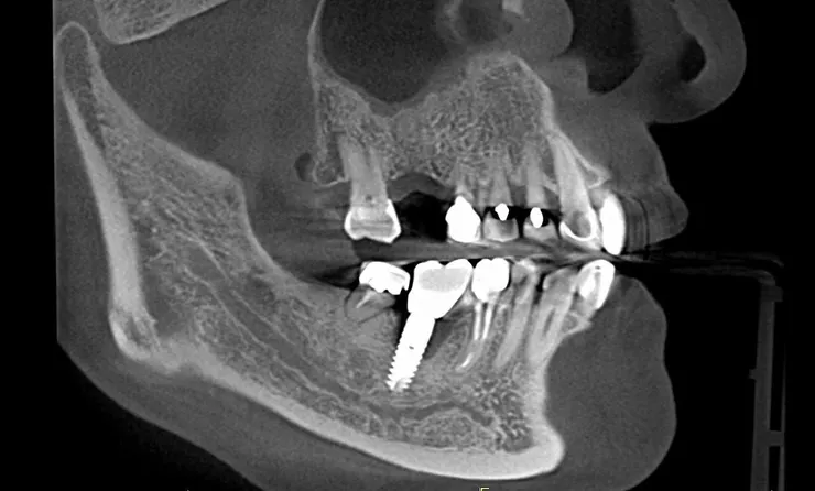 渥爾牙醫診所：植牙不只要穩，更要懂得「避震」！認識Bio-HPP新材料植體假牙