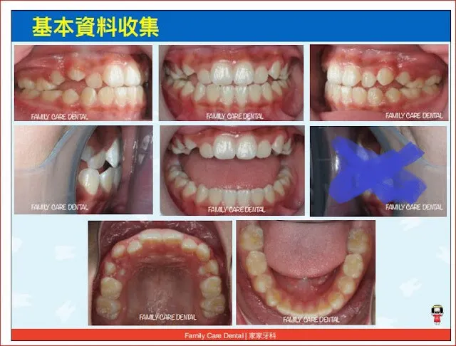 我現在口內照多以口腔掃描（口掃）替代，免去拉勾照相的痛苦，只有幾張做紀錄用的特寫，和口外照，把痛苦降到最低（有傳統矯正照相過的病人，大概知道我在講什麼）