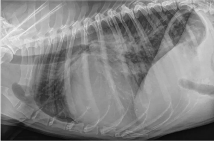 心臟擴張 肺積水