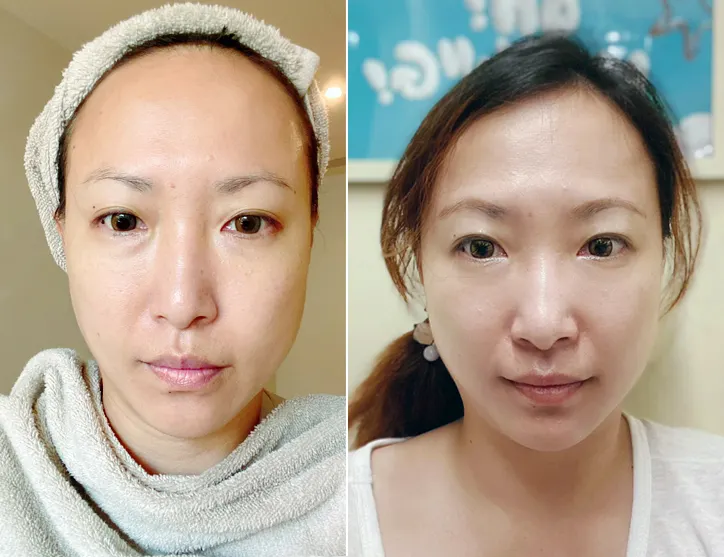 台北東區打雷射｜RedTouch PRO凍態雷射(果凍光)│台北打雷射推薦綻妍醫美診所