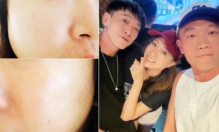 台北東區打雷射｜RedTouch PRO凍態雷射(果凍光)│台北打雷射推薦綻妍醫美診所