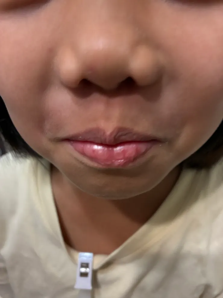 鼻孔下部紅通通