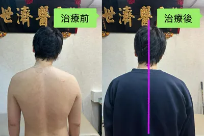 年輕實業家的左肩疼痛--左病右治，上病下治案例