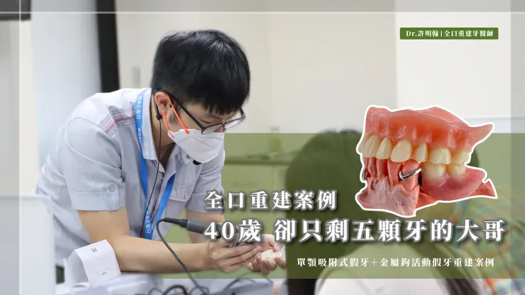  全口重建案例 40歲卻只剩五顆牙的大哥