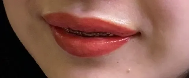 麻藥還沒退看起來很搞笑😂