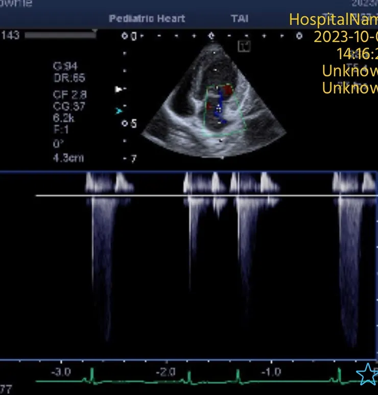 心臟超音波二尖瓣繞流