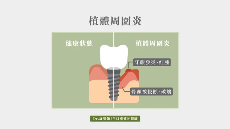 植牙的牙周病 植體周圍炎