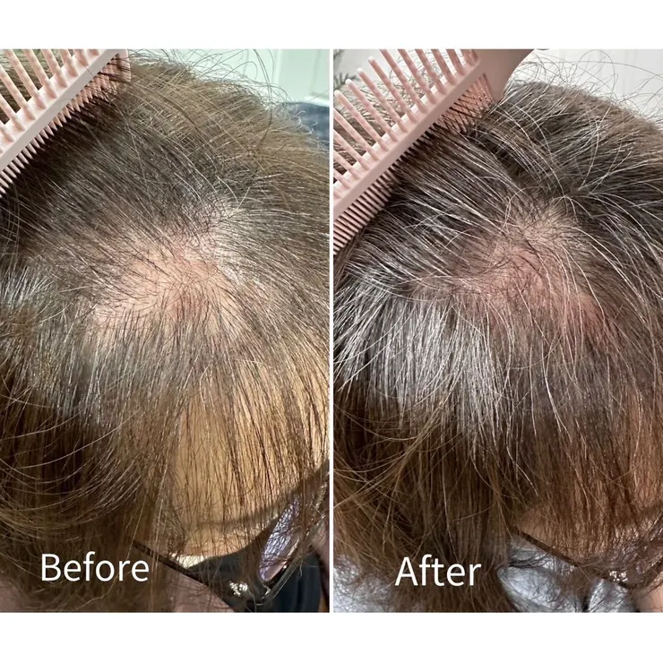 做了兩次，相隔七週的實拍，差異肉眼可見。而且實際上的成效比照片能呈現出來的還要更好