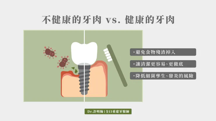 植牙補肉的三個優點