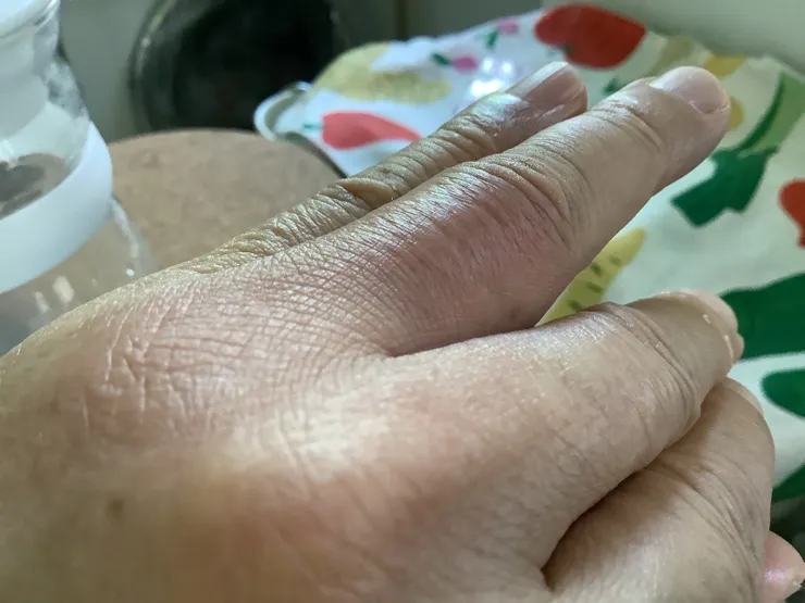 圖二：事發後第二天的傷指腫脹發紅