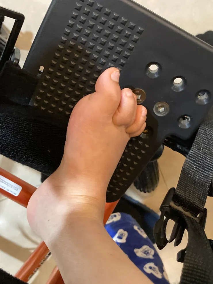 這一次出院連四肢都浮腫成這樣，腸胃科醫師讓我們幫祂開胃造口，我們拒絕。我寧願辛苦一點替祂追食量。