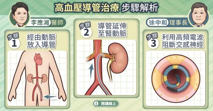 高血壓導管治療步驟