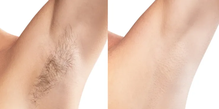 私密處與腋下除毛美白全攻略 告別暗沉異味打造清爽光滑肌！