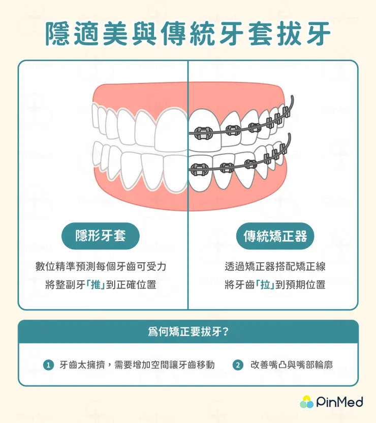 隱適美拔牙vs傳統牙套拔牙