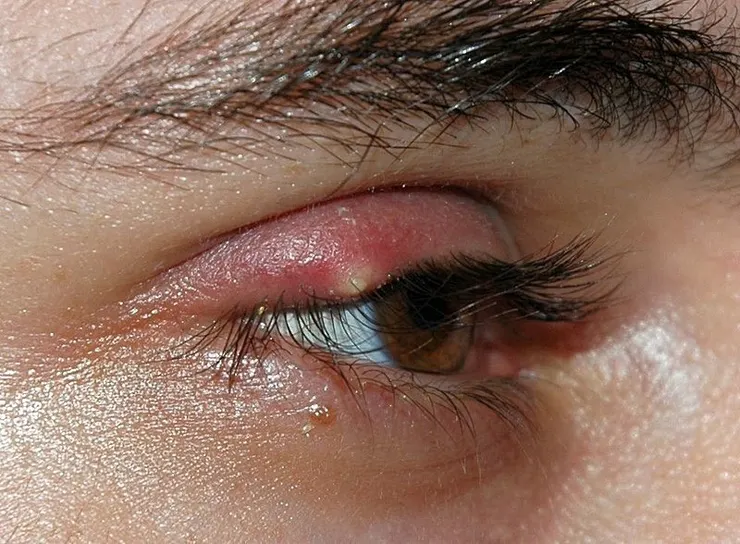 Stye—Wikipedia