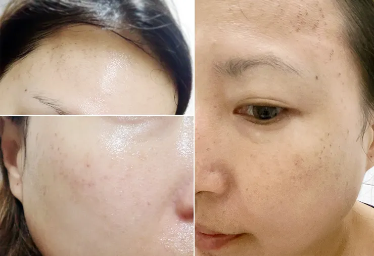 台北東區打雷射｜RedTouch PRO凍態雷射(果凍光)│台北打雷射推薦綻妍醫美診所