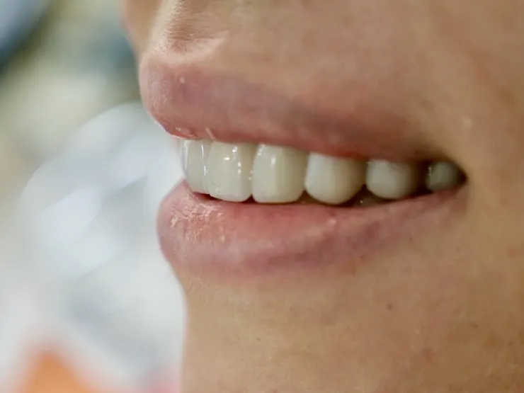 一笑傾城，氣質全開！客製化明眸鋯齒貼片(牙齒貼片)打造專屬你的自信笑容！